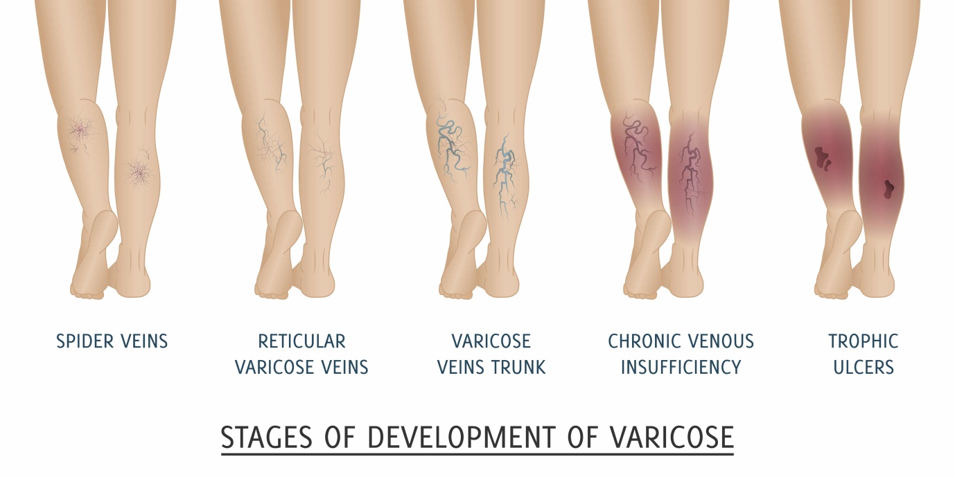 Varicose vein